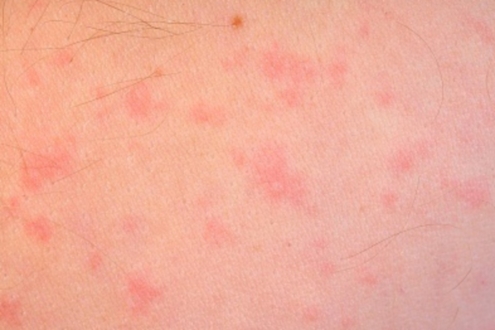 skin rash caused by food allergy