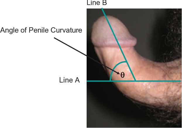curvature picture of penis pointing upwards