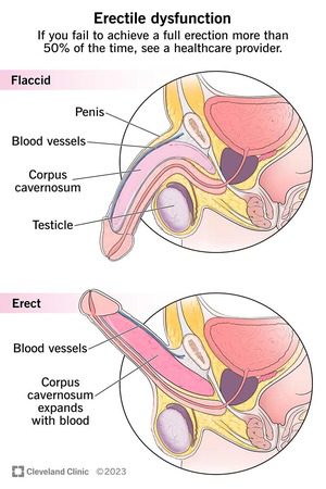 illustration of how proenhance patch helps to combat erectile dysfunction