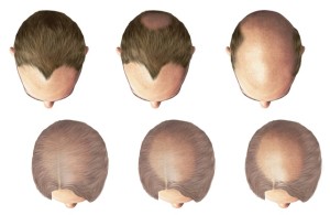 male type baldness
