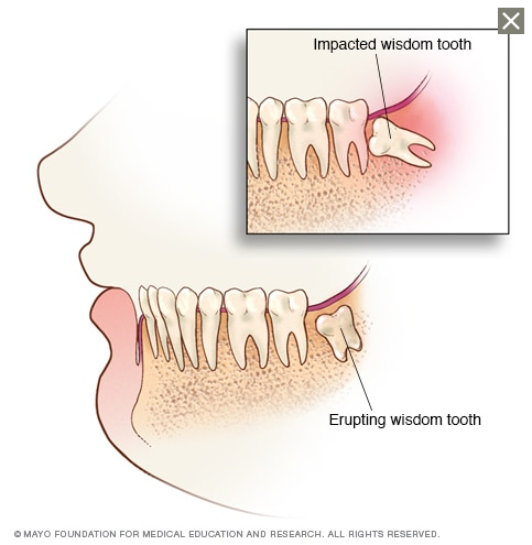 impacted wisdom teeth courtesy of mayo clinic