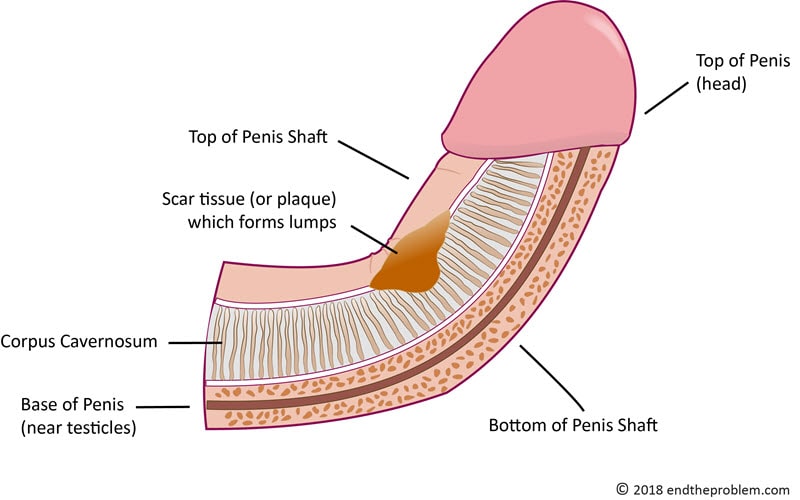 fix bent penis